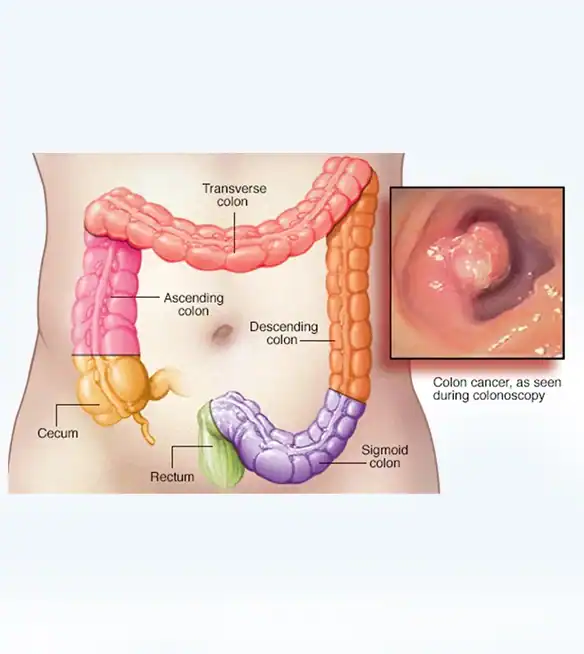 colorectal-cancers